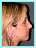 Plastic surgery of the nasal septum for facial aesthetics and rhinoplasty.