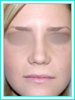 Surgery aesthetics nose for facial aesthetics and operation of nasal septum.
