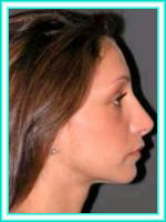 Operation nose and facial aesthetic plastic surgery.