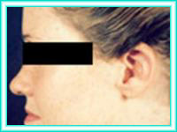 Operacion de nariz y cirugia de orejas sobresalientes.