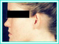 Otoplastia para orejas prominentes con cirugia de nariz.