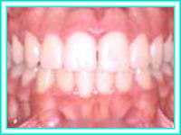 Teeth whitening adults aesthetics with brackets