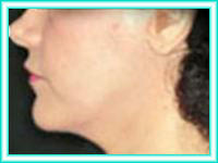 Implantes dentales con cirugia estetica y cirugia facial.