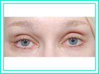 Cirugia de bolsas de los ojos para rejuvenecimiento facial.