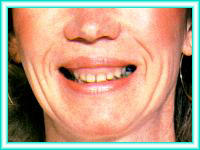 Estetica dental con ortodoncia denta y blanqueamiento.