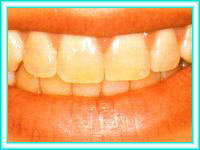 Implantes de dientes con ortodoncia para estetica dental.