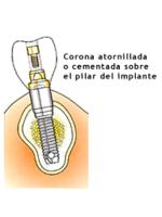 Dentales implantes y odontologia estetica en clinica de implantes.