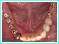 Implantes dentales en clinica de colocacion y estetica.