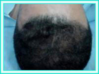 Implantes de pelo e implantes capilares para la calvicie.