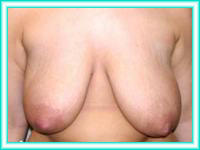 Implantes de siliconas para pechos, cirugia estetica de mamas.