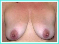Siliconas para implantes de mama y elevacion.