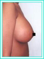Aumento de senos y busto con implantes de siliconas con operacion.
