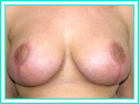 Elevacion de mamas y pechos con implantes de siliconas.