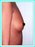 Implantes de senos con cirugia, operacion para aumento de mamas.