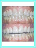 Implante de dientes y estetica dental en clinica.