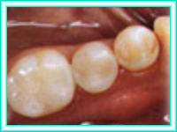 Estetica dental y colocacion dental con implantes.