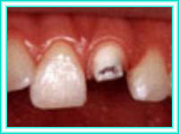 Odontologia estetica y colocacion de dientes.