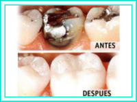 Colocacion dental y estetica dental en clinica.