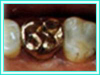 Implante de dientes en cursos de implante dental.