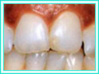 Implante dental y estetica en clinica dental.