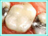 Implante de dientes en clinica de colocacion dental.
