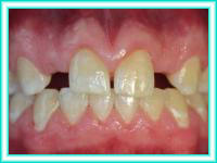 Implante de dientes y estetica de dientes en clinica.