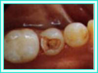 Implante de dientes en cursos de odontologia.