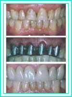 Implante dental y estetica dental en clinica.