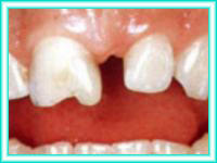 Implante de dientes y colocacion en clinica de dental.