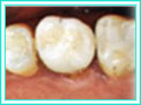 Implante dental en clinica de colocacion de dientes.