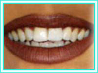 Implante dental y estetica en clinica de colocacion.