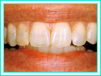 Cursos de implante dental y estetica dental.