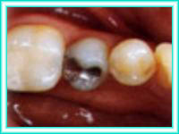 Dental implante y estetica en clinica de implante.