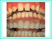 Colocacion de implante dental y estetica de dientes.