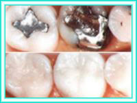 Colocacion de dientes y estetica dental con implantes.