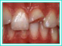 Implante dental en curso de odontologia estetica.