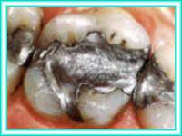 Implante dental en cursos de implante de dientes.