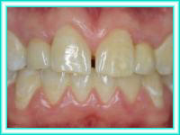 De dientes implante y colocacion en clinica de implante.
