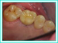 Dental implants in clinics of dentistry and placement.