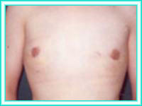 Reduccion mamaria por cirugia de mamas para pechos grandes.
