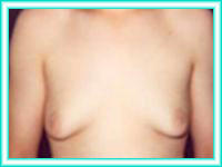 Reduccion de pechos grandes y estetica senos con cirugia.