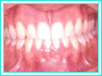 Brackets en dientes para ortodoncia estetica dental.